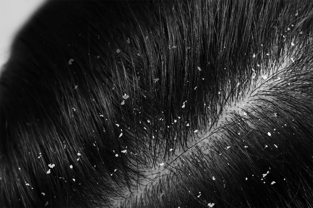 Men’s Guide to Dandruff, Hair Loss, and Breakage